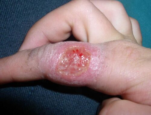 Leishmaniasis Cutánea