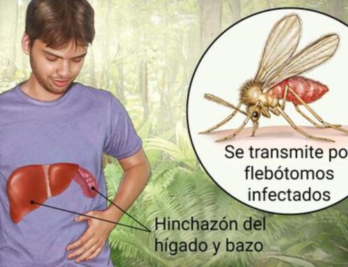 Leishmaniasis Visceral